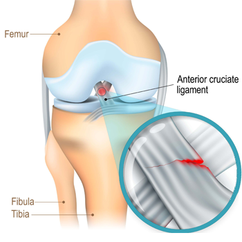 ACL Reconstruction
