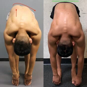 Lower Back Muscle Imbalance