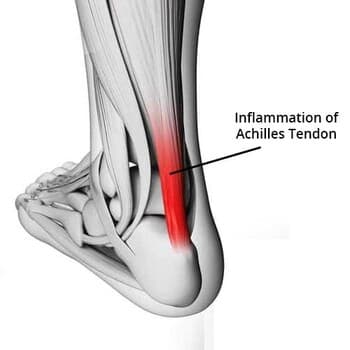 Achiles Tendonitis