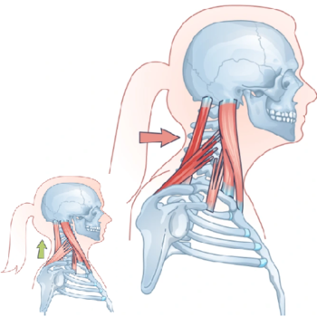 Forward Head Posture